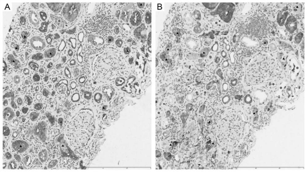 Marker for predicting range and depth of kidney infection of polyoma virus and application thereof