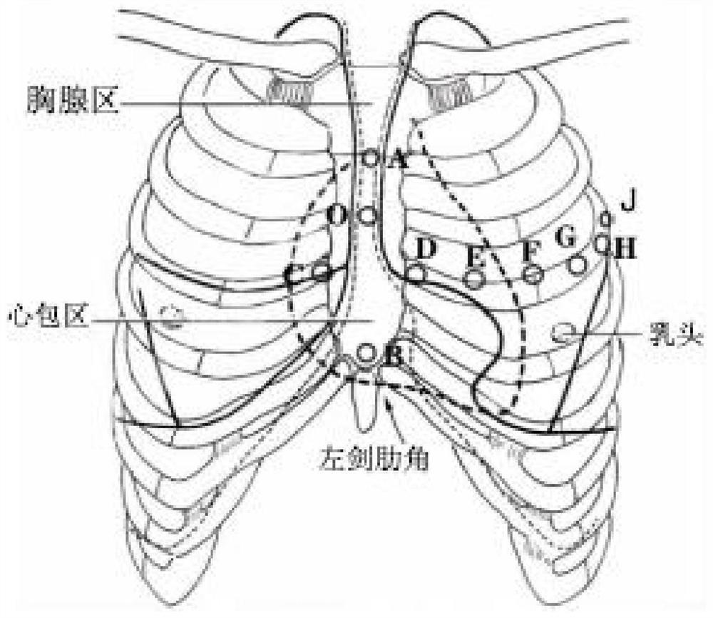 Novel 12-lead system easy for computer electrocardiosignal feature recognition