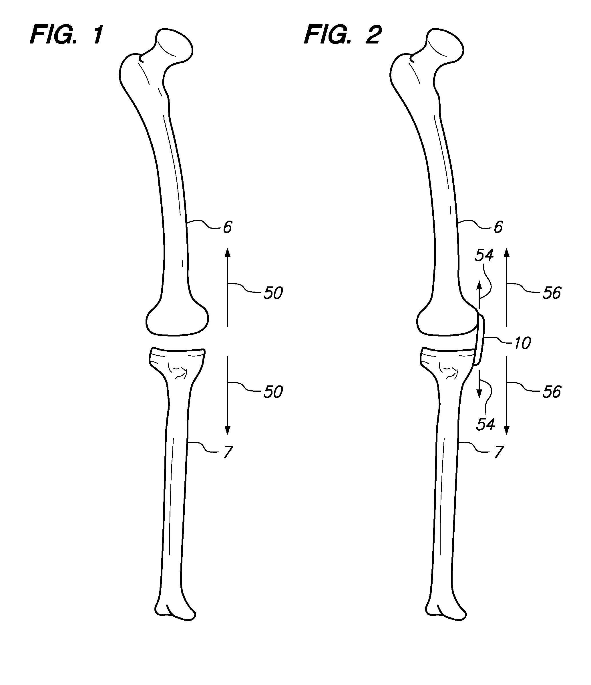 Extra-articular implantable mechanical energy absorbing assemblies having two deflecting members and methods