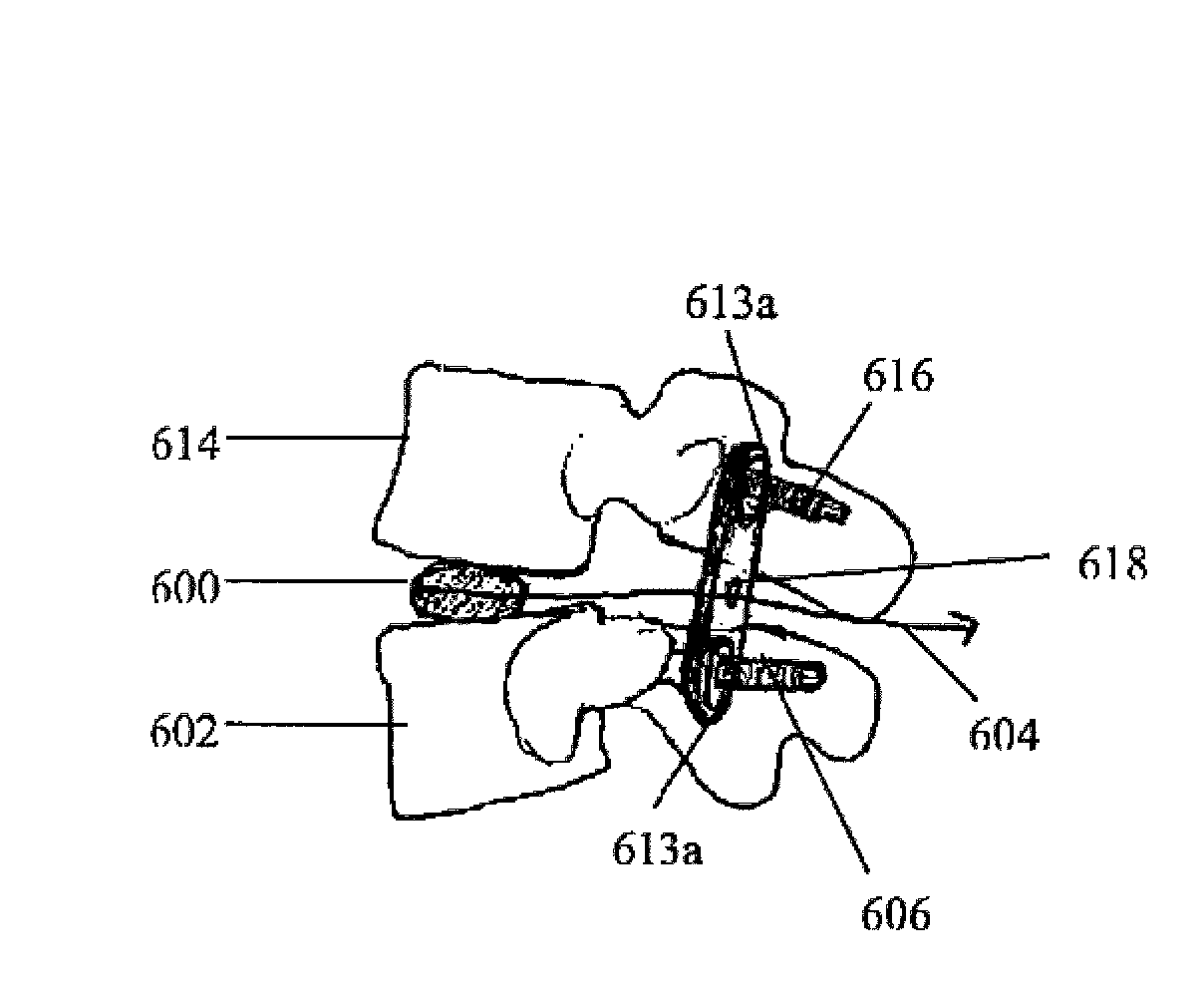 Methods of implanting a motion segment repair system