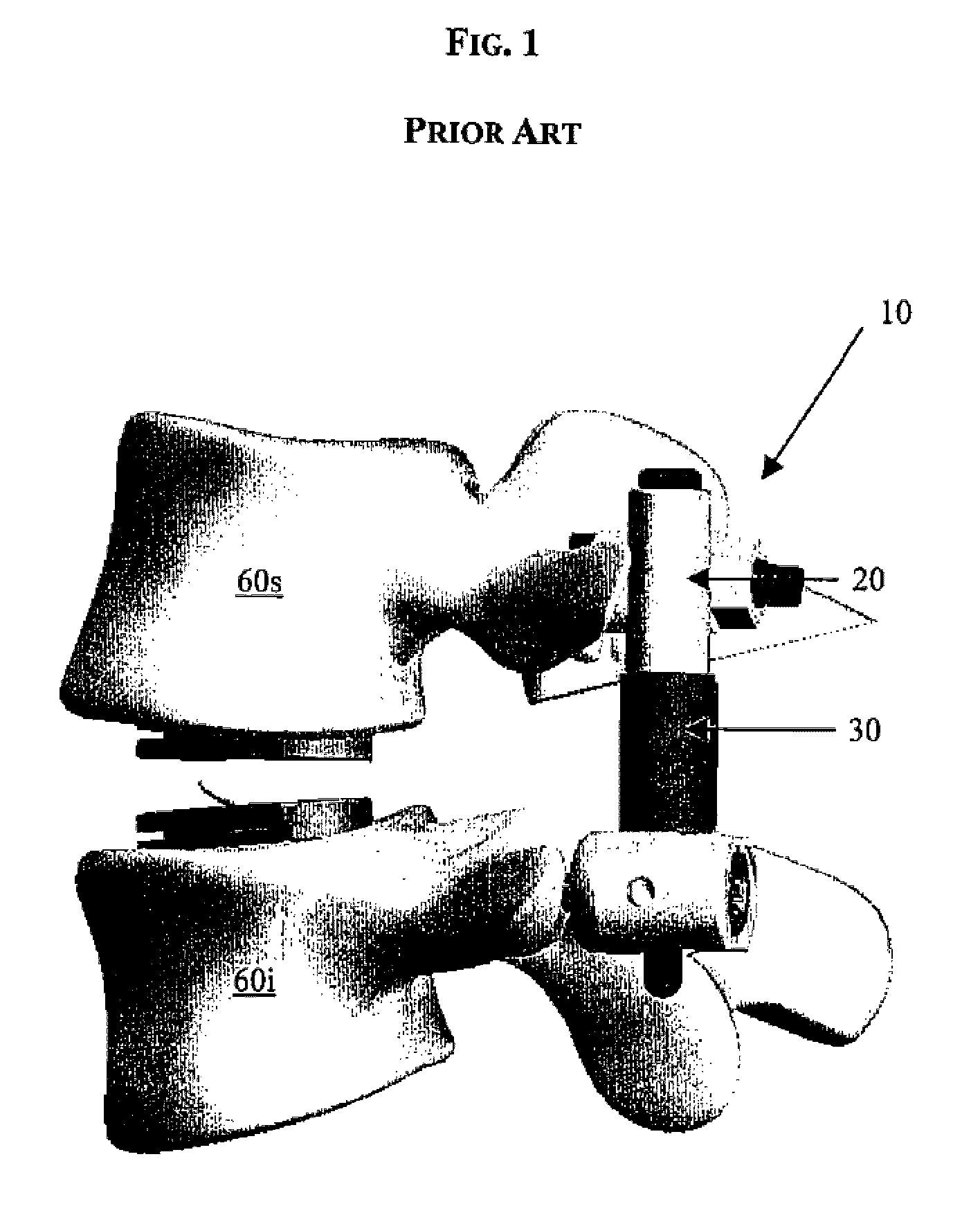 Methods of implanting a motion segment repair system