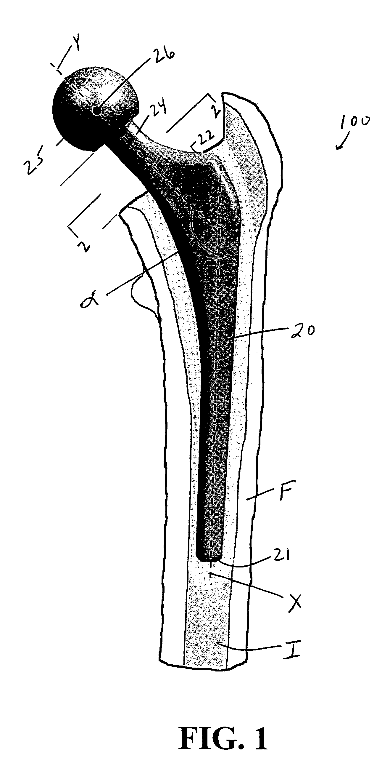 Femoral implant for hip arthroplasty