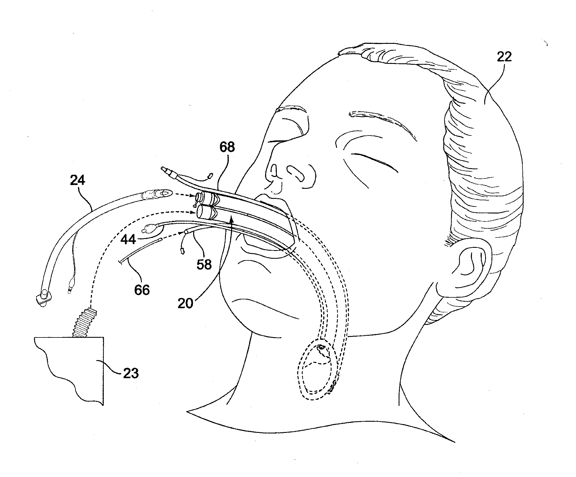 Airway device, airway assist device and the method of using same