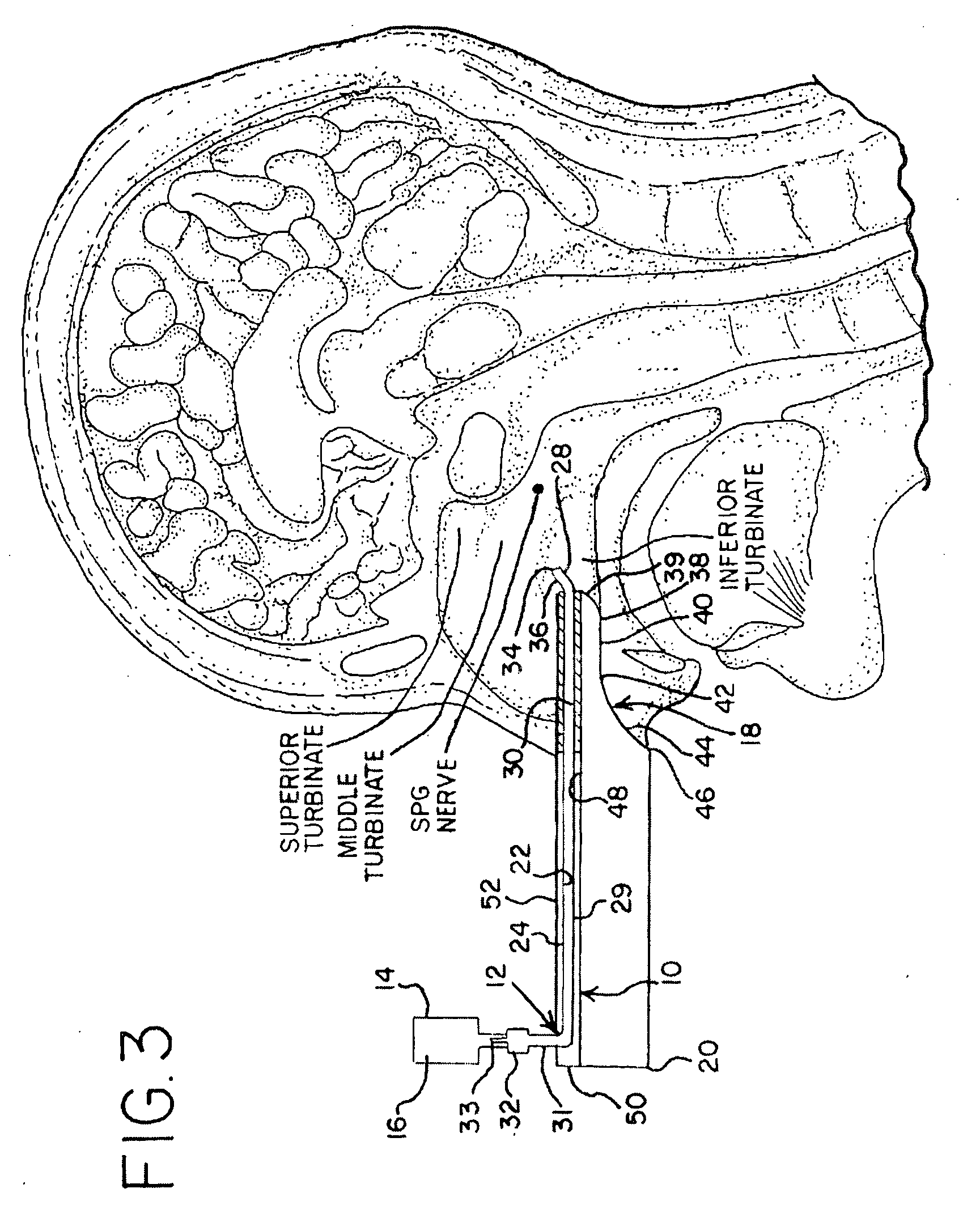 Apparatus and Method for Controlling Headaches