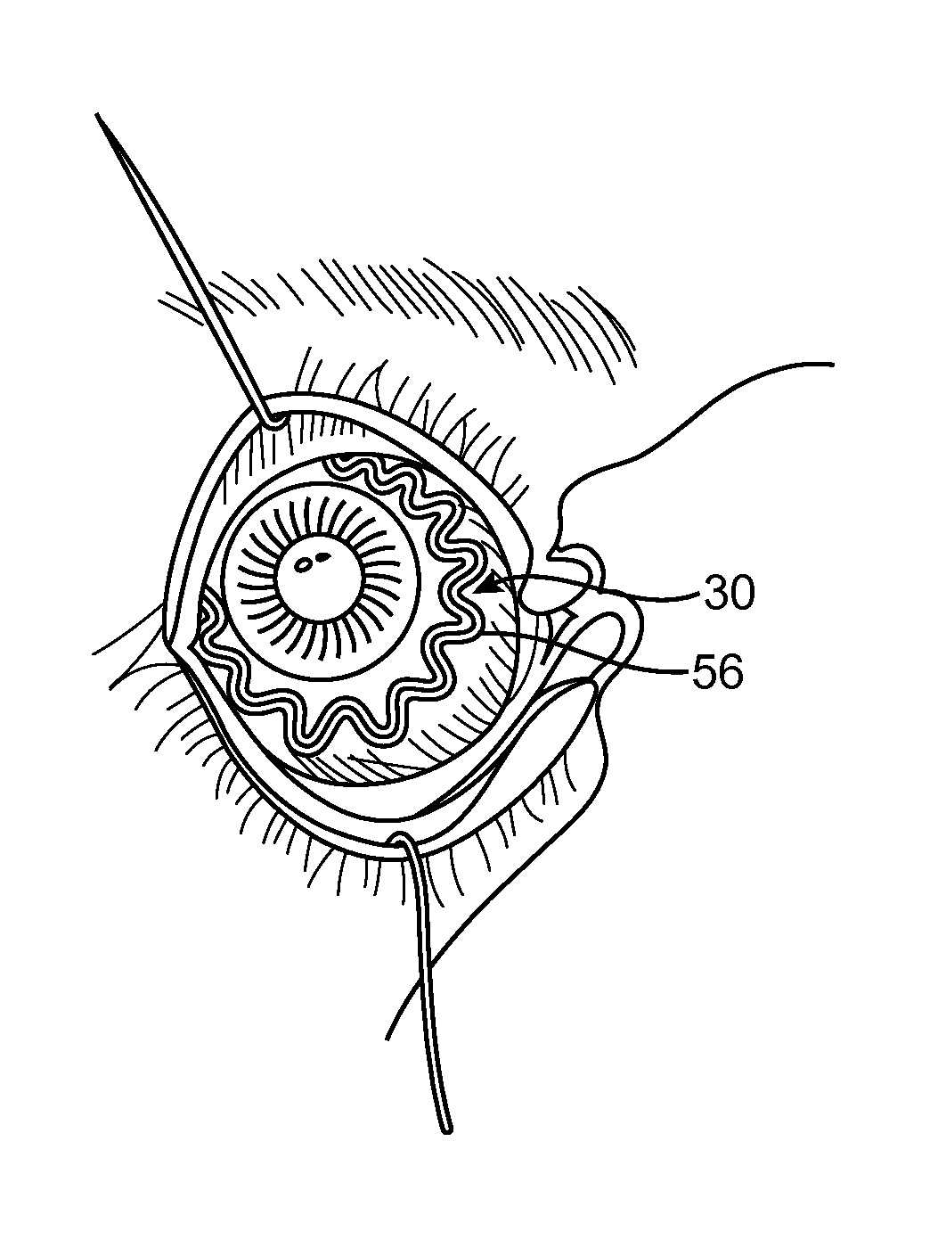 Anterior segment drug delivery