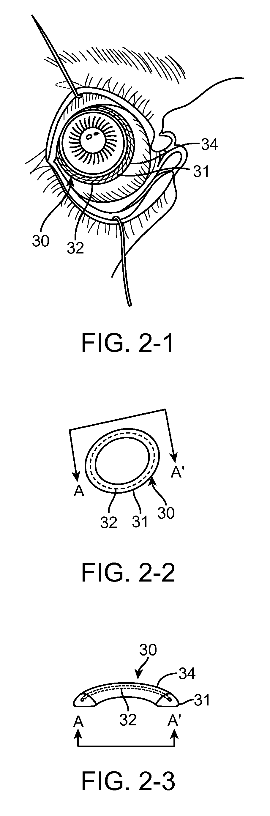 Anterior segment drug delivery