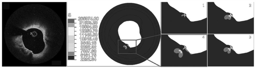 A Simplified Calculation Method and Plaque Rupture Risk Quantification Evaluation System Based on Coronary Multimodal Image Crack Formation and Extension