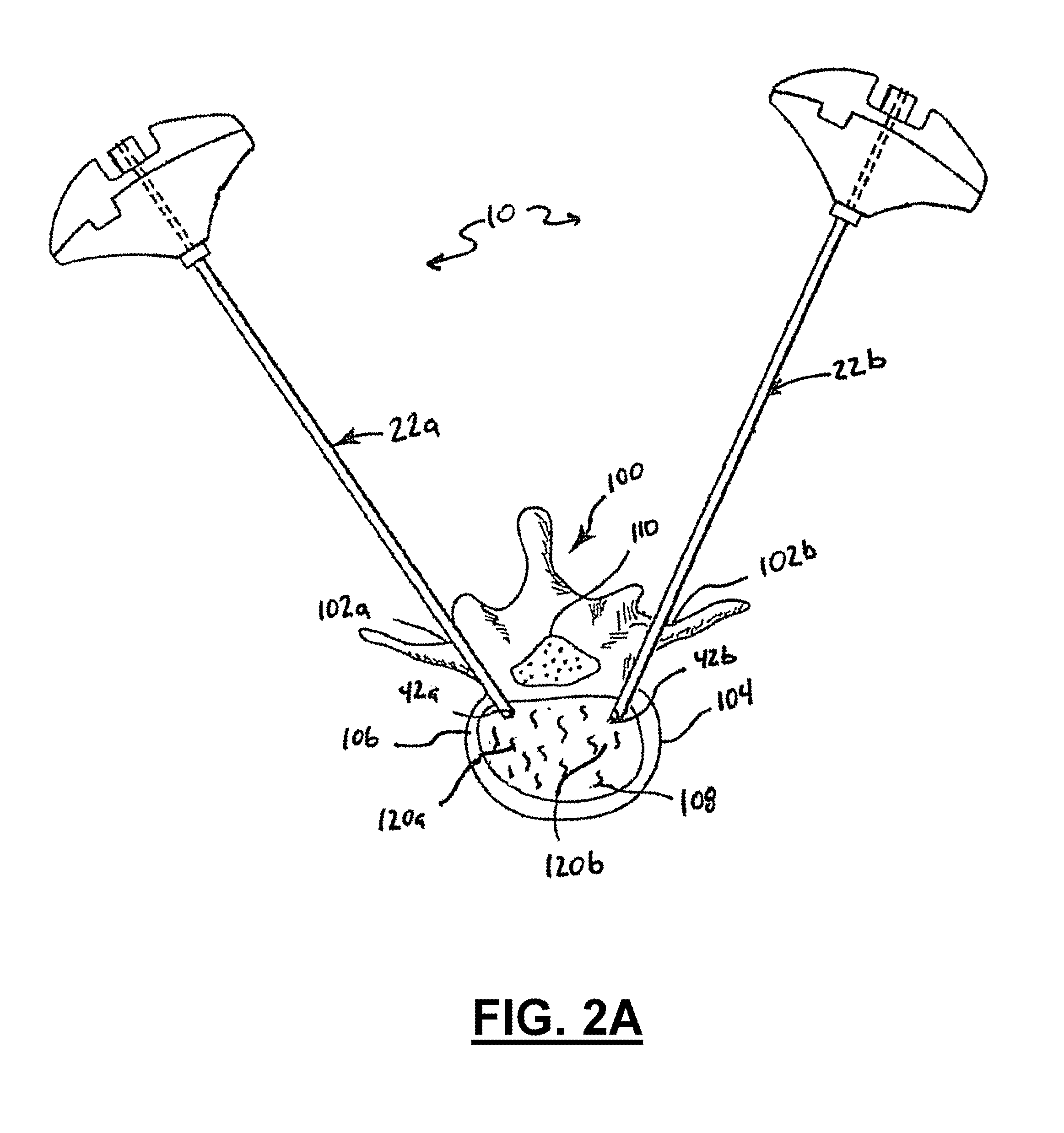 Apparatus and method for stylet-guided vertebral augmentation