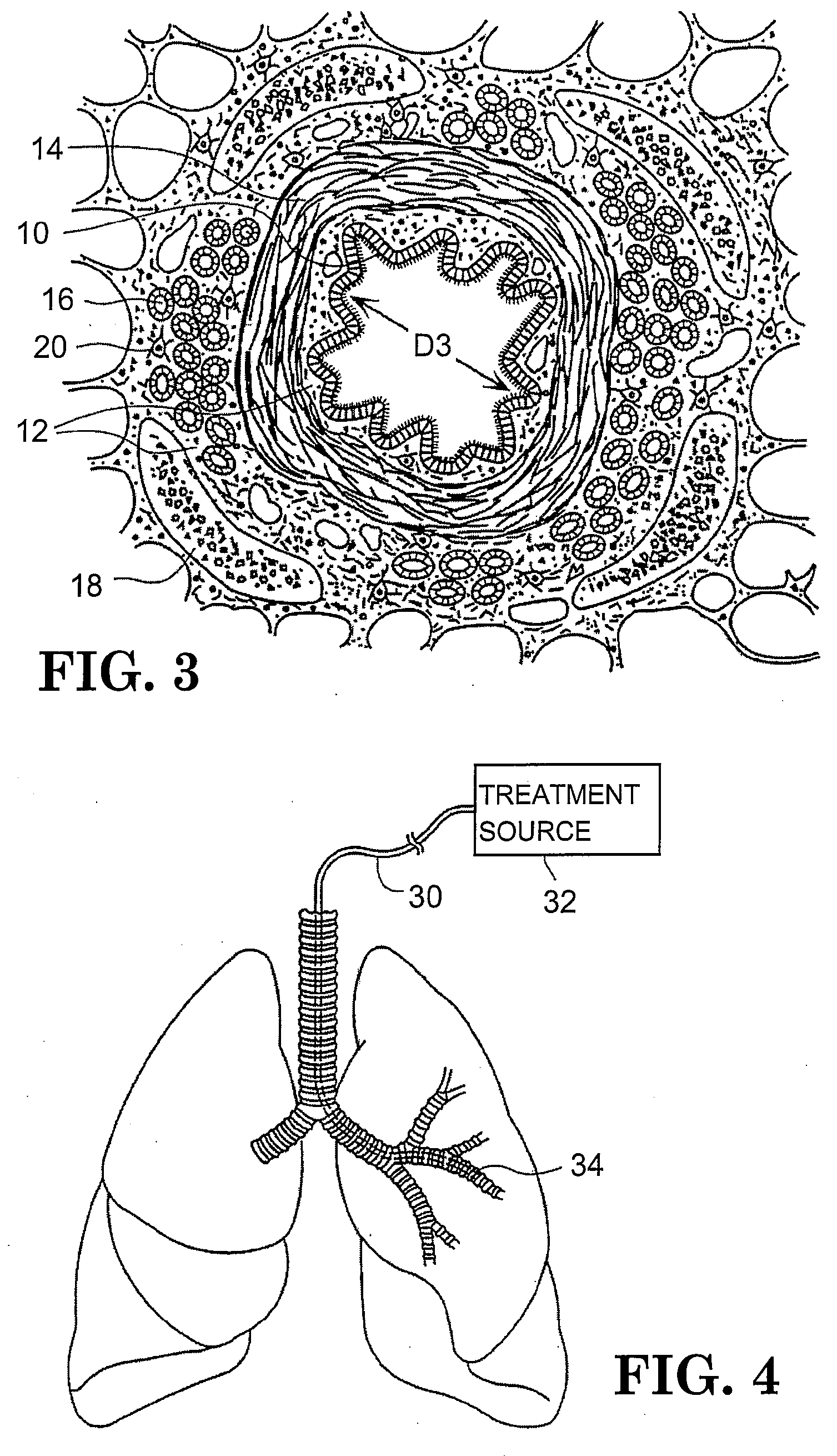 Apparatus for treating airways in the lung