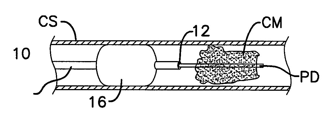 Visualization of coronary vein procedure