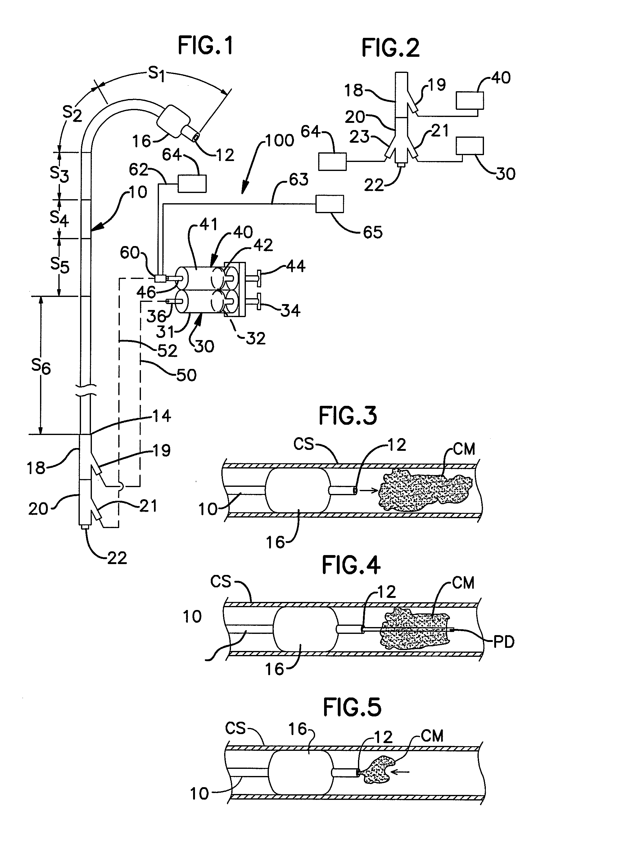 Visualization of coronary vein procedure