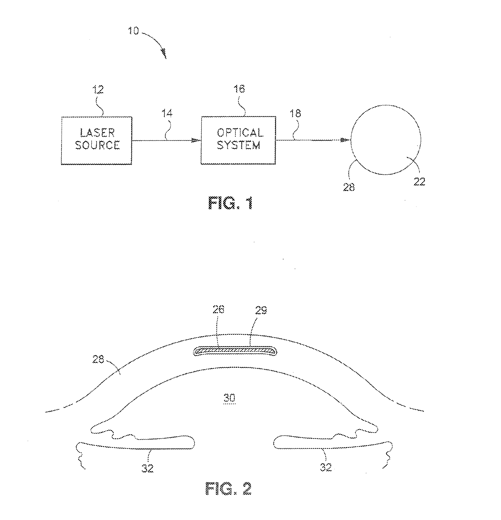 Method for Laser Cutting a Corneal Pocket