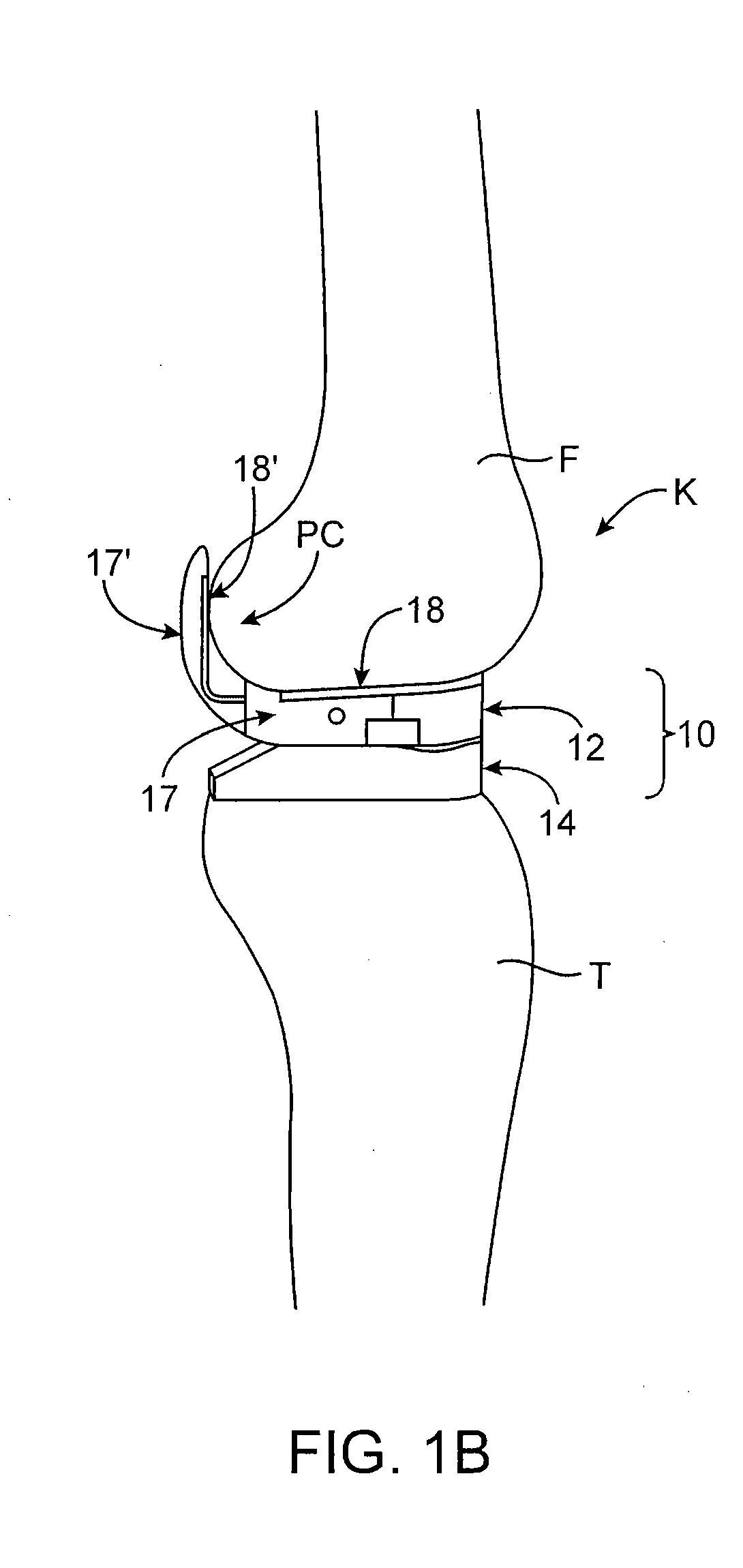 Dynamic knee balancer with force or pressure sensing