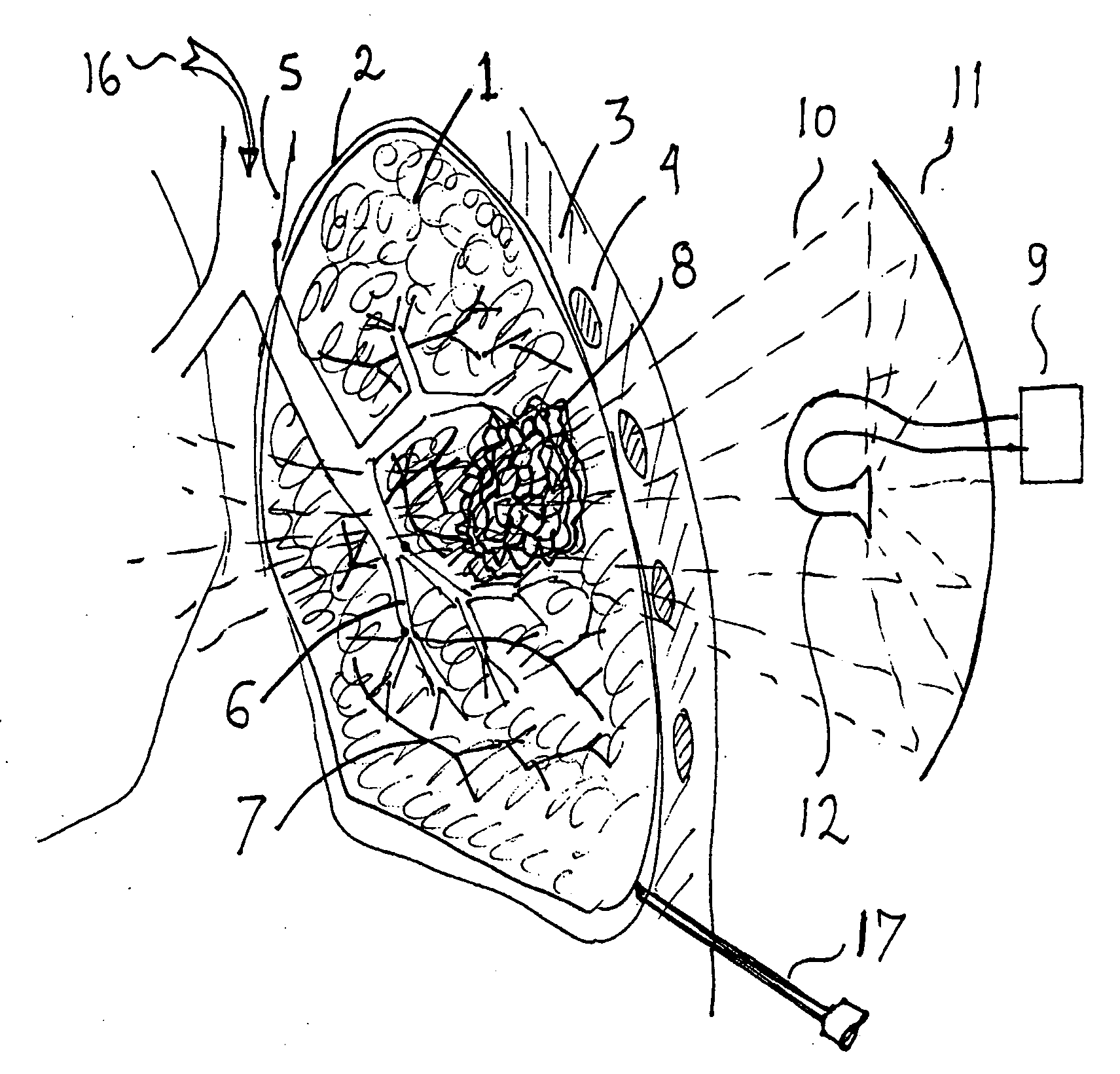 System for treating undesired body tissue