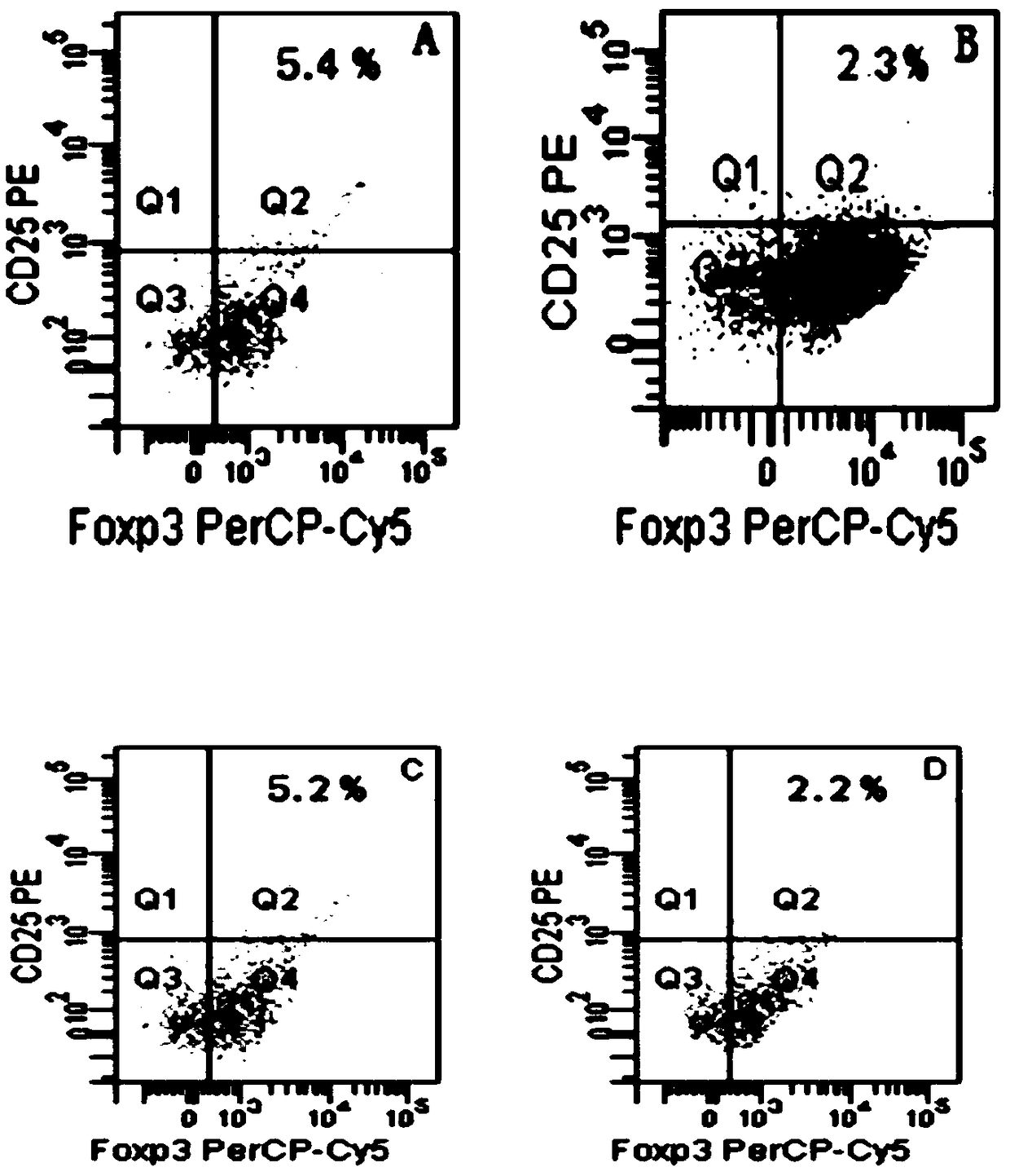 Interference sequence of IL-17 gene closely related to primary nephrotic syndrome podocyte injury