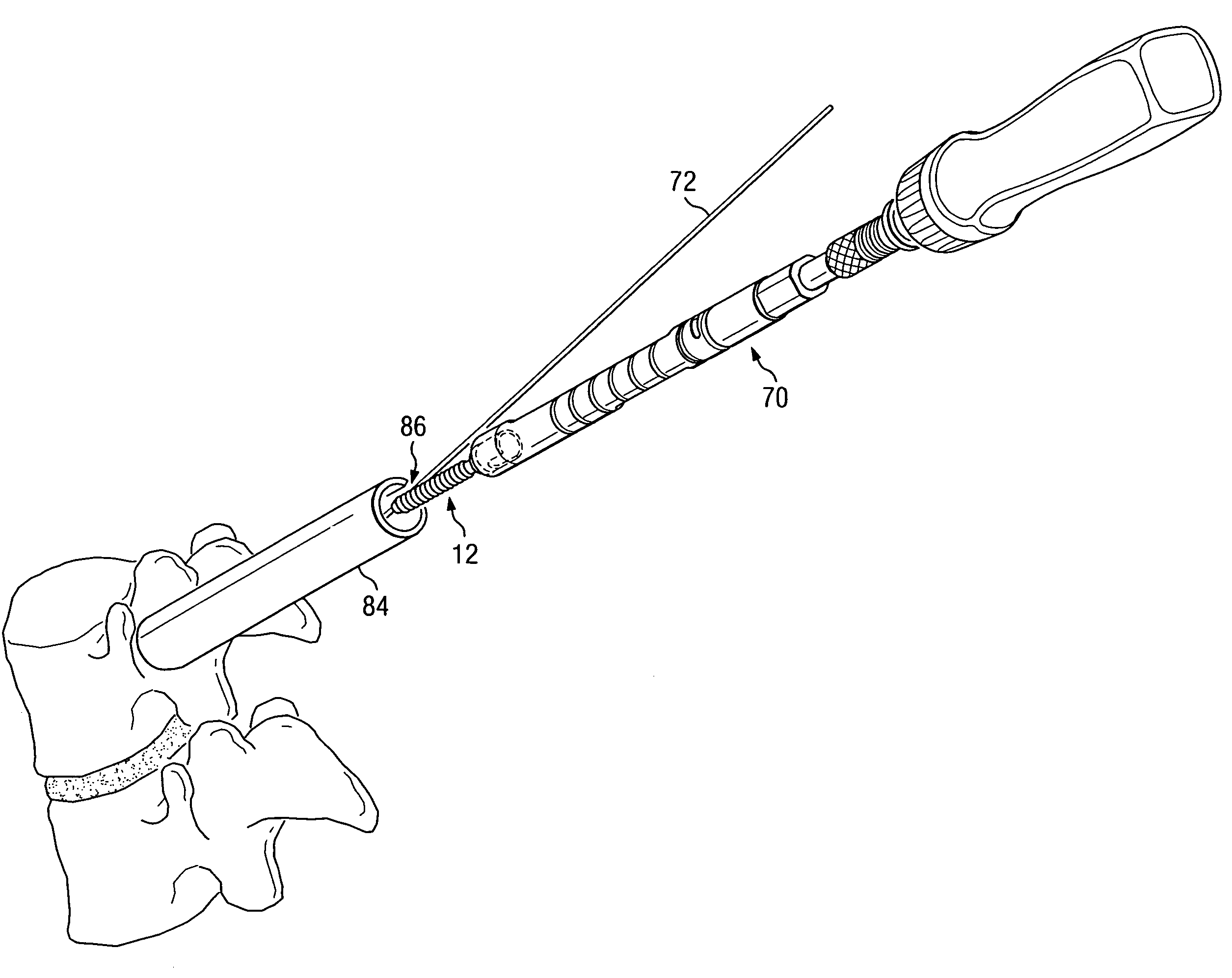 Off-axis anchor guidance system