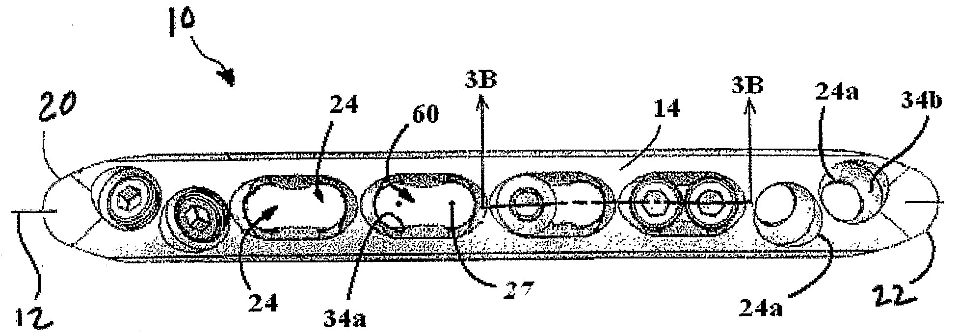 Bone Plate with Complex, Adjacent Holes Joined by a Relief-Space