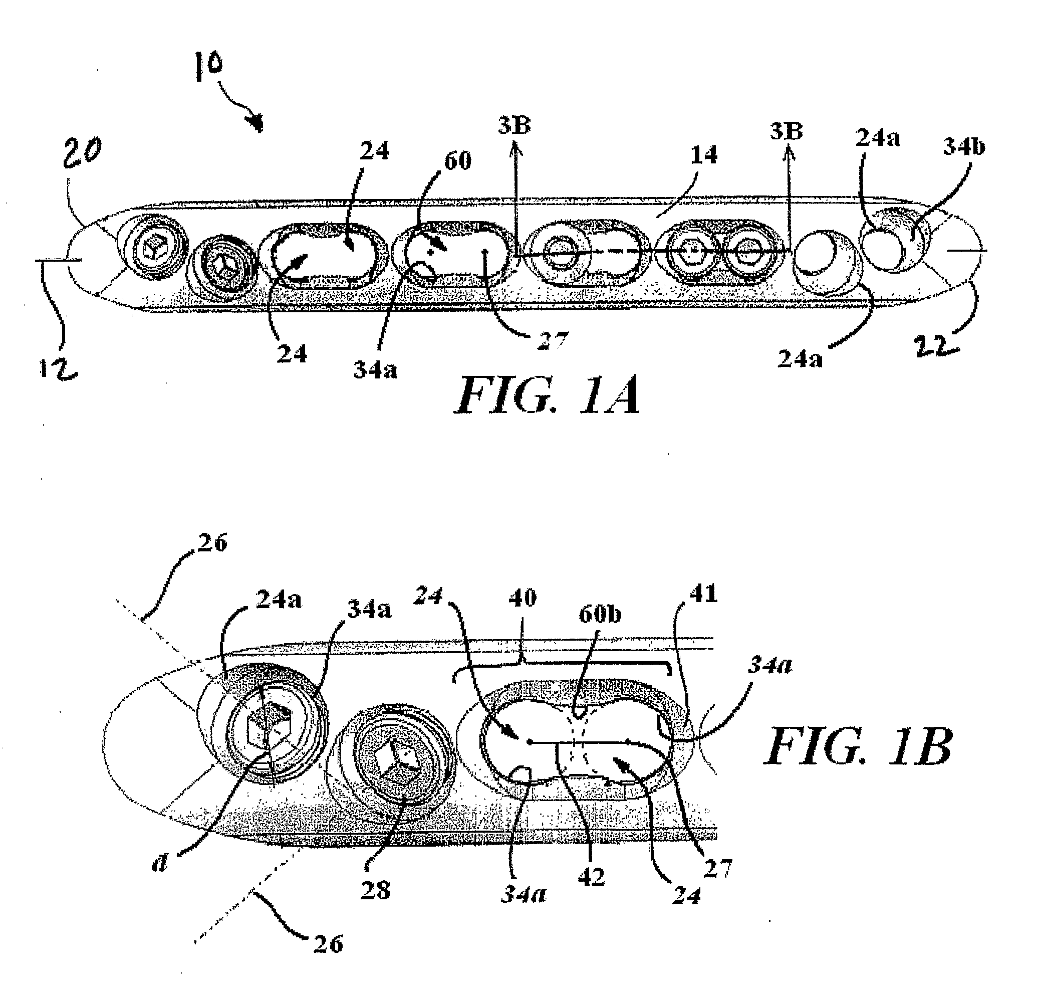 Bone Plate with Complex, Adjacent Holes Joined by a Relief-Space