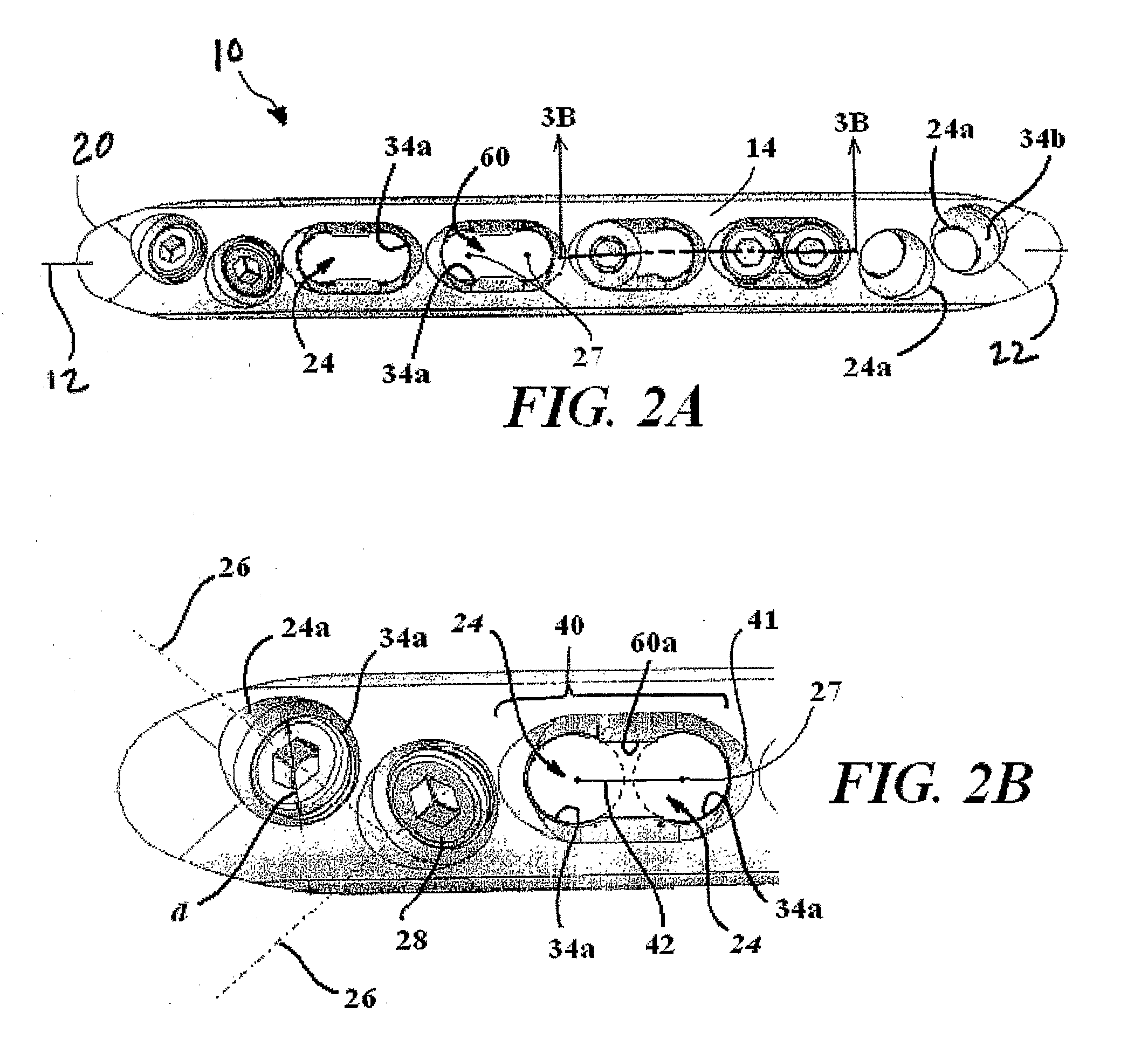 Bone Plate with Complex, Adjacent Holes Joined by a Relief-Space