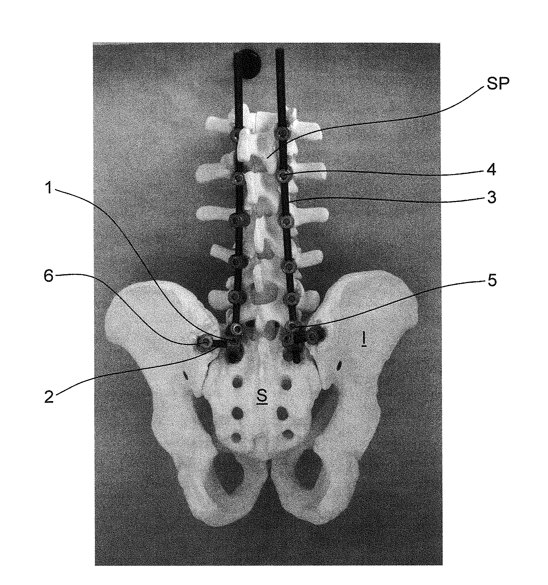 Iliac connector, connector head, spinal fixation system and method of stabilizing a spine