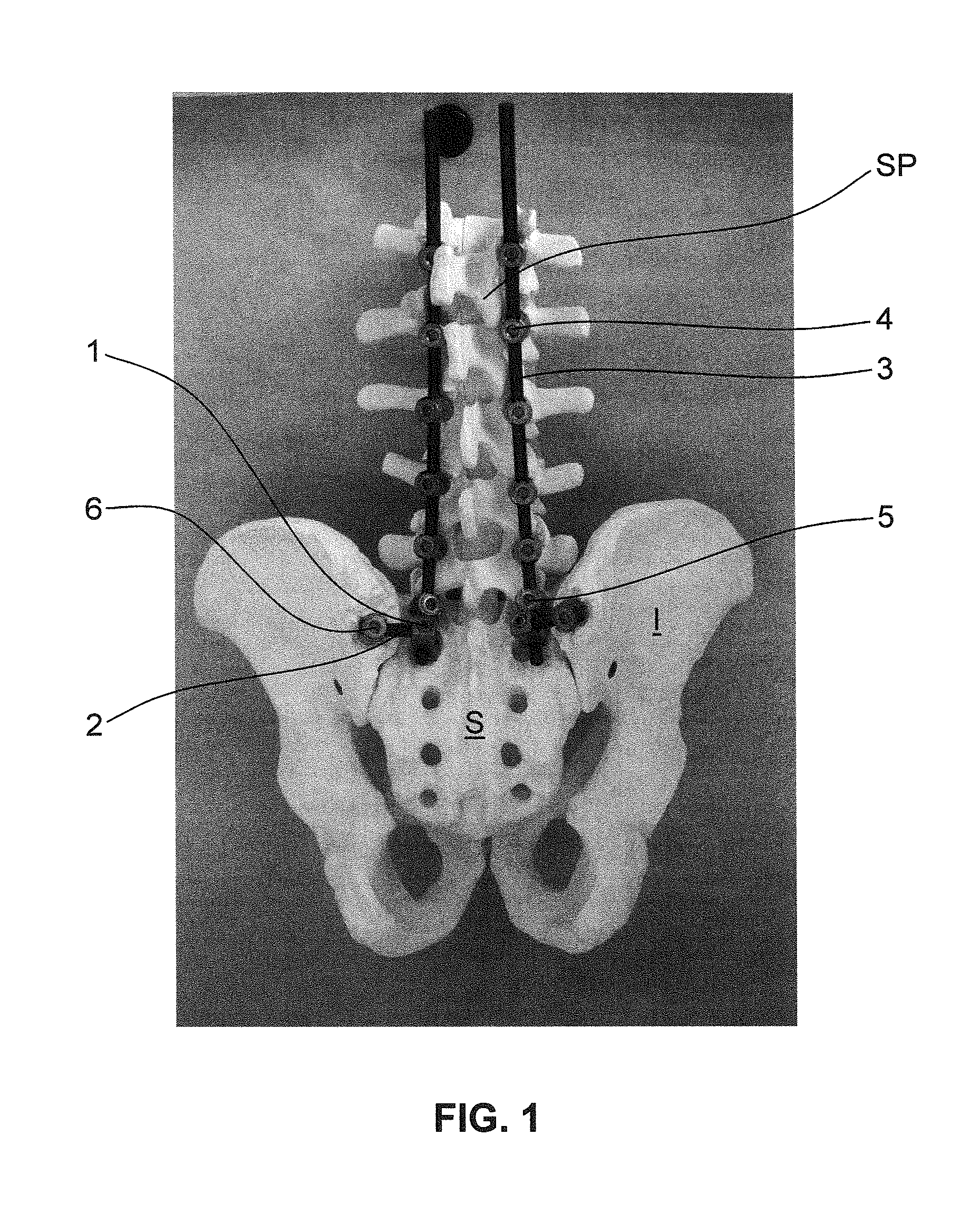 Iliac connector, connector head, spinal fixation system and method of stabilizing a spine