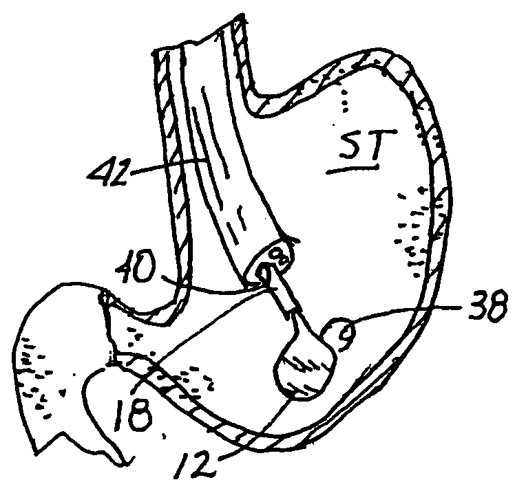 Surgical kit, closure device, and associated method