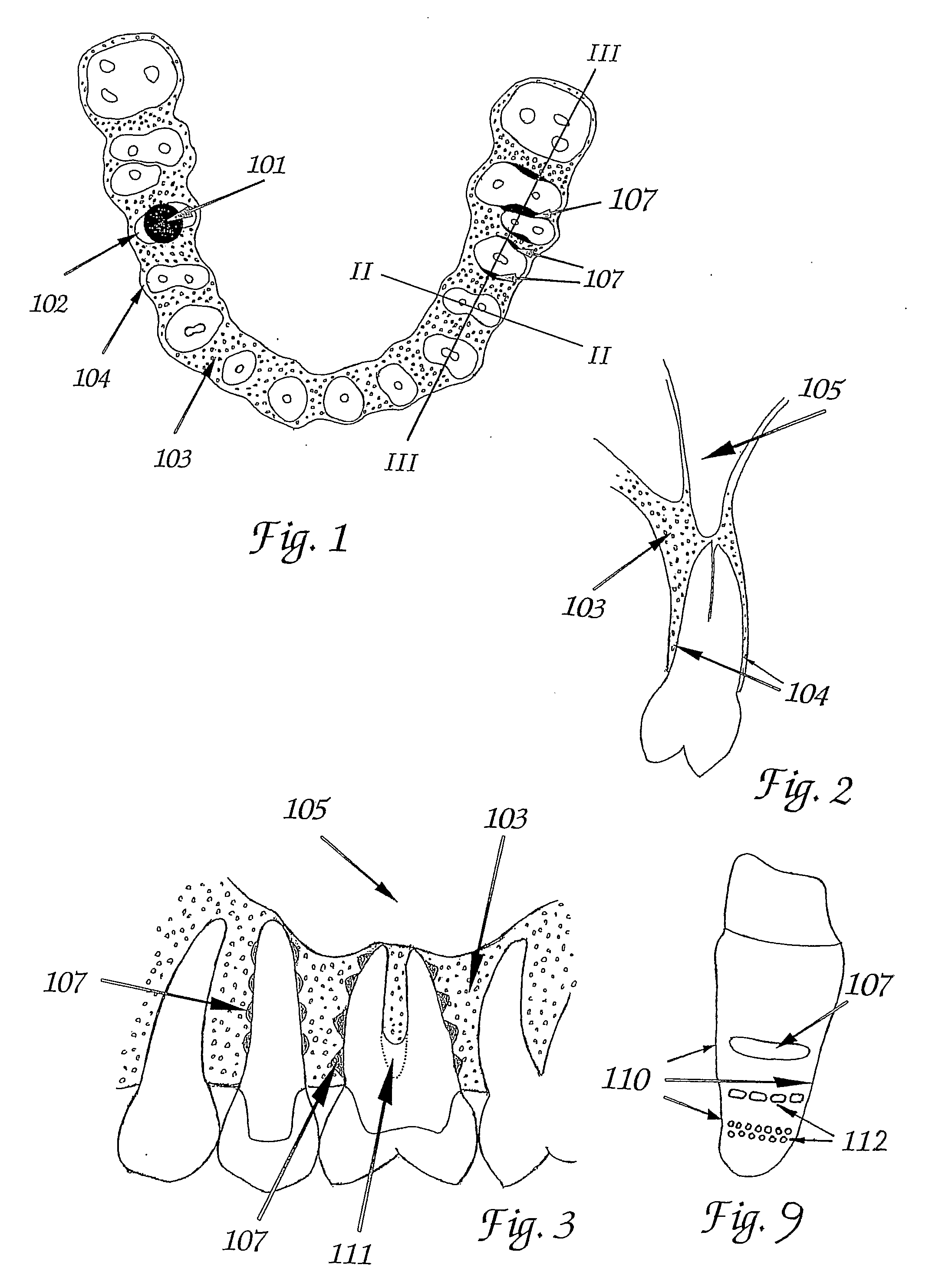 Tooth Implant