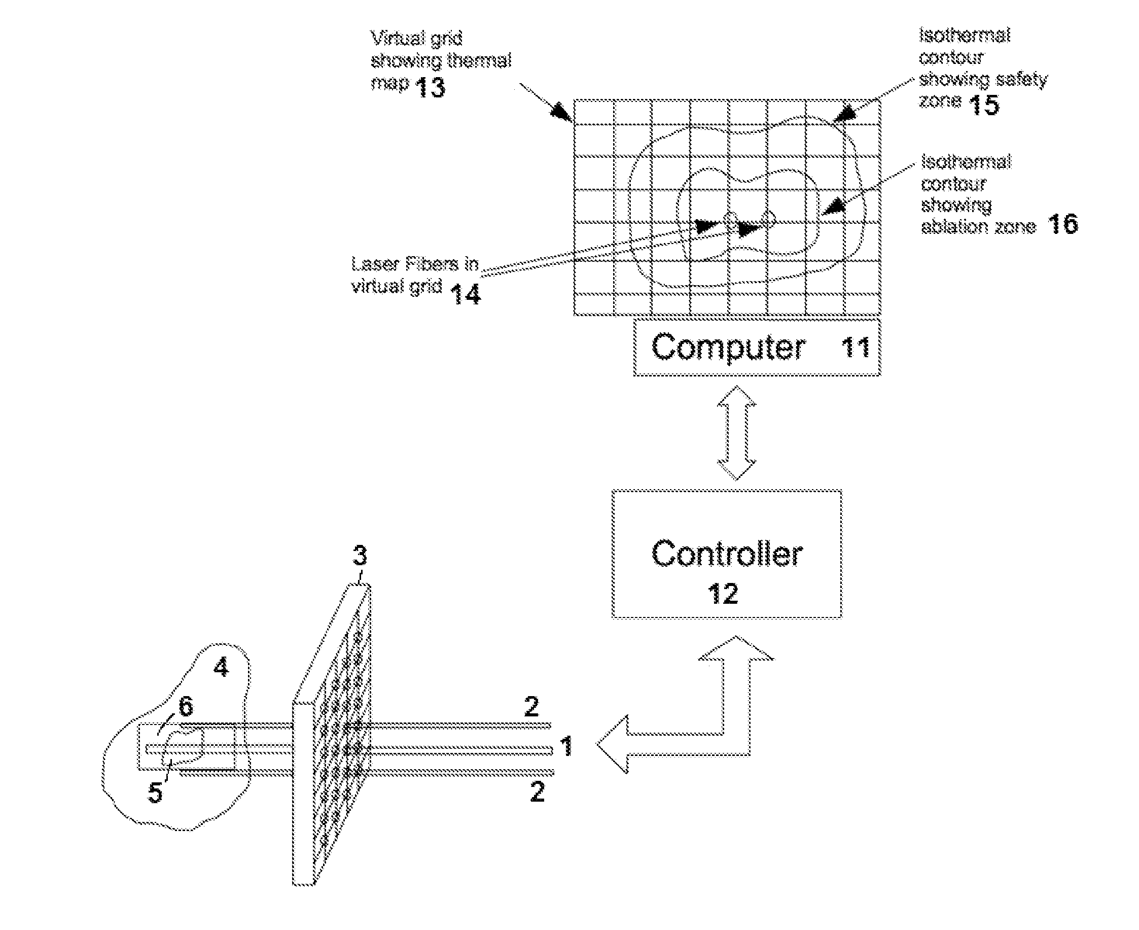 Method and apparatus for laser ablation under ultrasound guidance