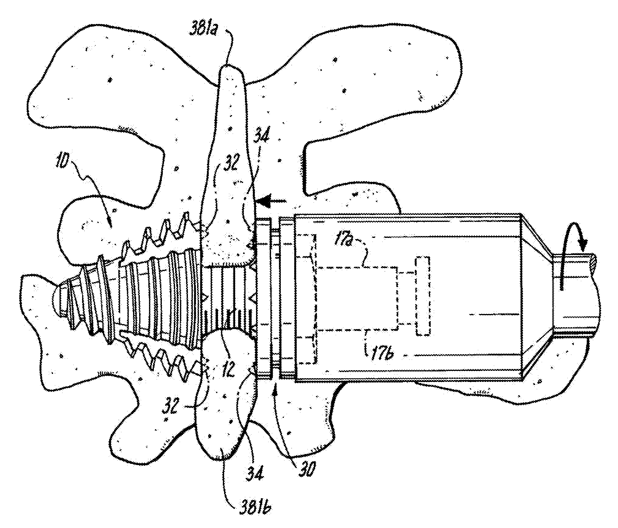 Interspinous Process Implant and Fusion Cage Spacer