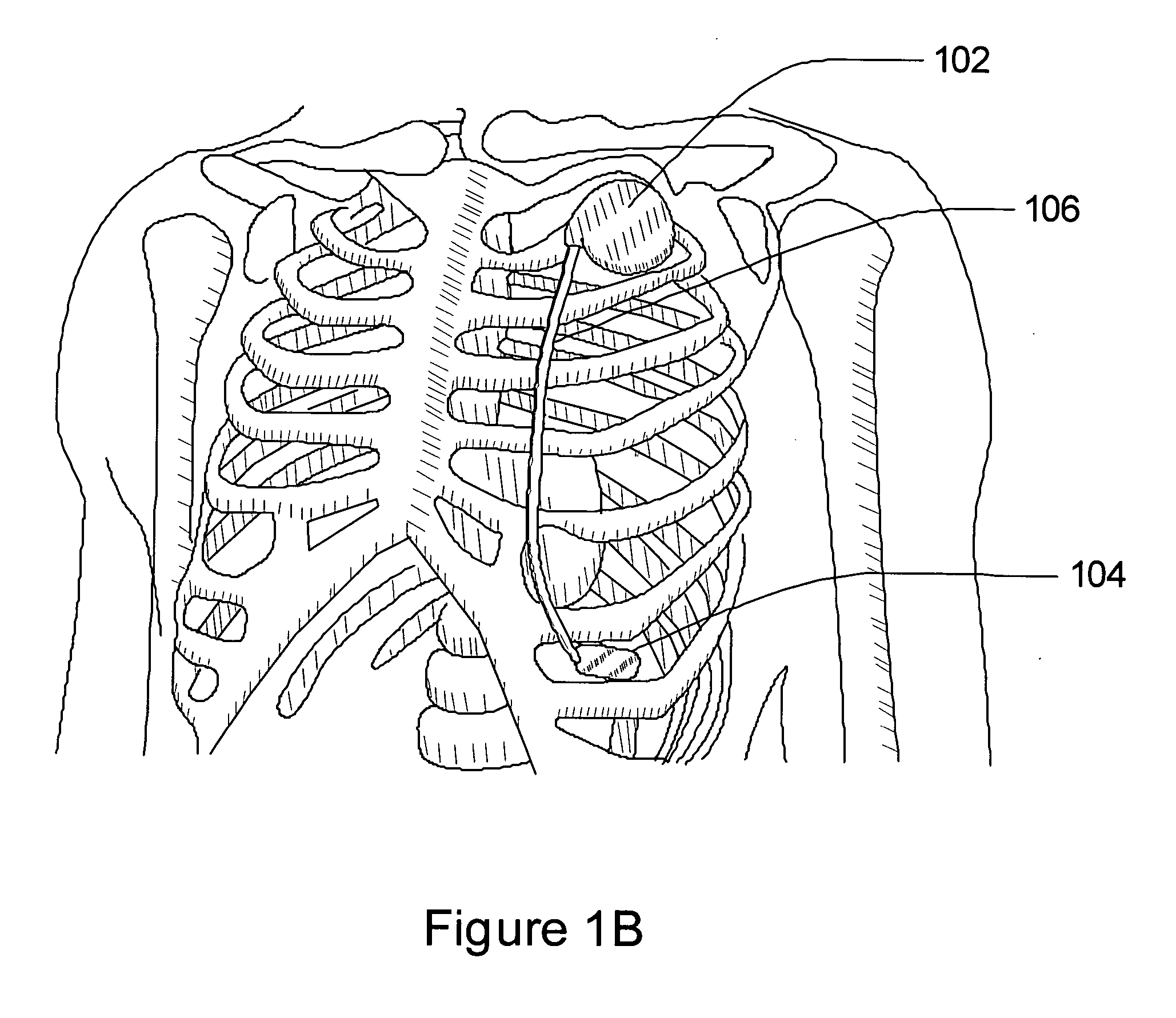 Patient stratification for implantable subcutaneous cardiac monitoring and therapy