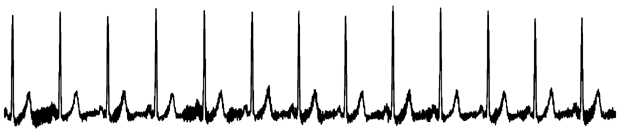 A method for analyzing cardiac shock signals to calculate short-term heart rate values