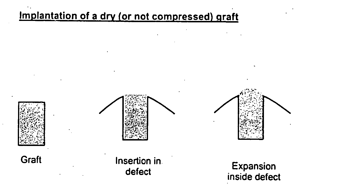 Expandable cartilage implant