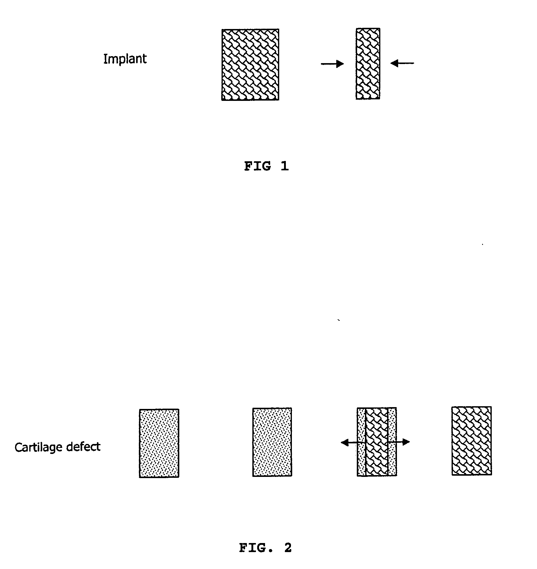 Expandable cartilage implant