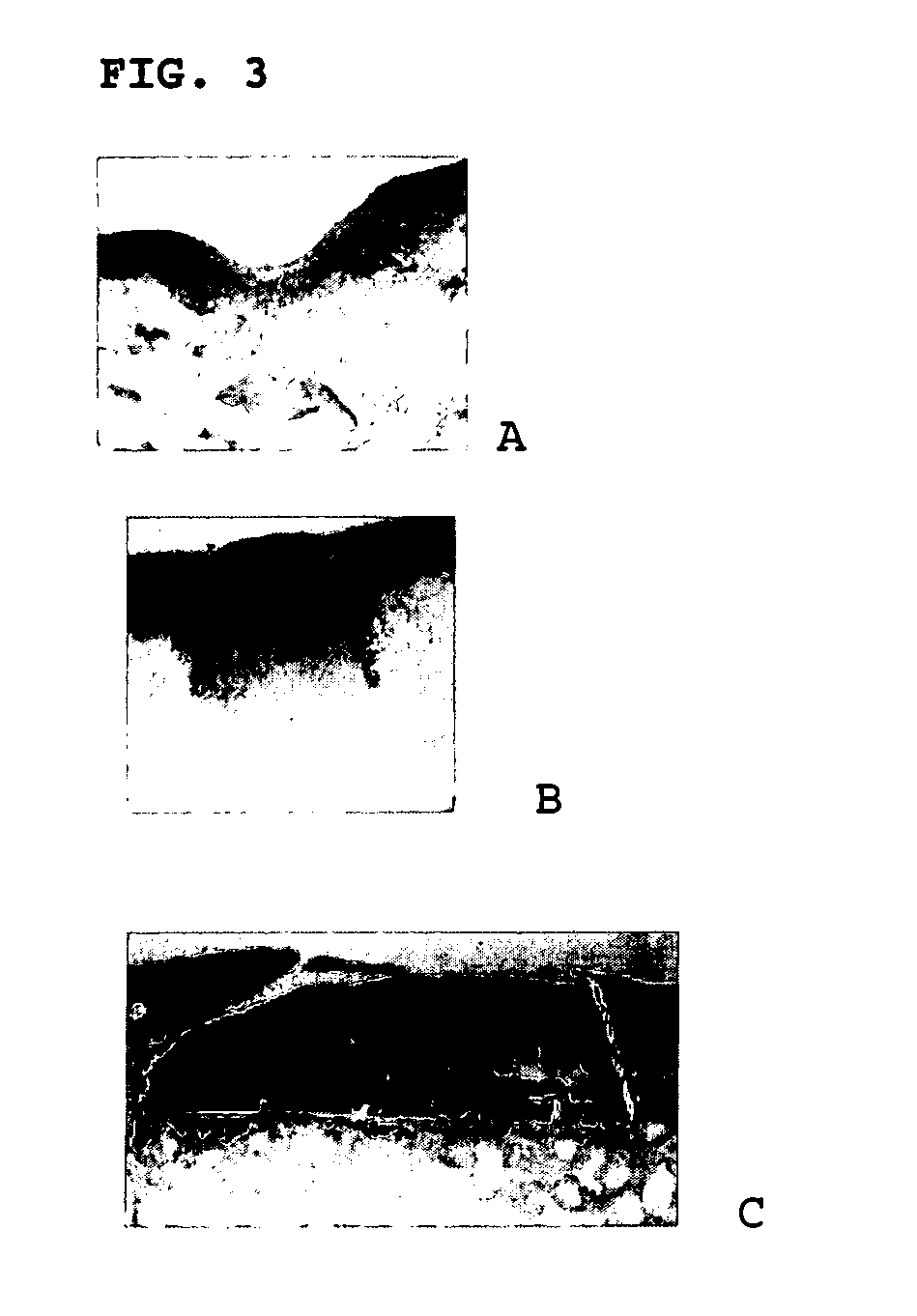 Expandable cartilage implant