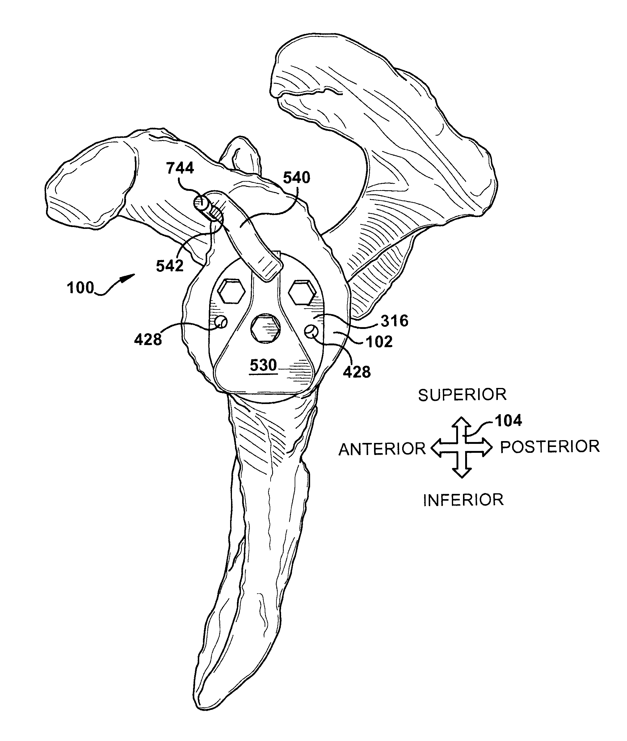 Guide for assisting with arrangement of a stock instrument with respect to a patient tissue