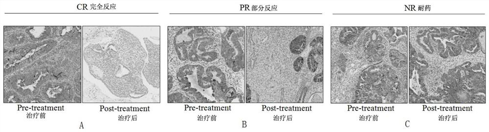 Detection kit taking AKR1C1 as detection target and use method of detection kit