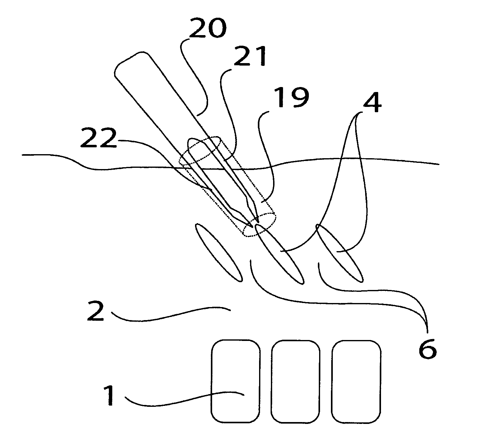 Technique and device for laminar osteotomy and laminoplasty