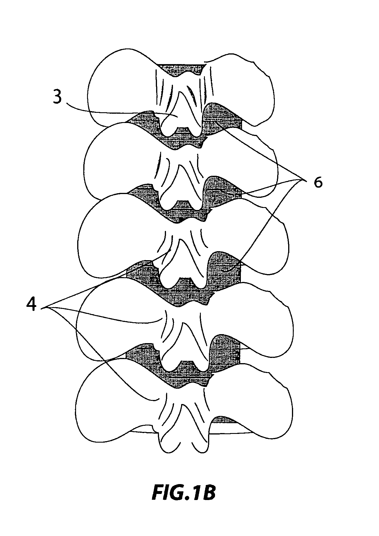 Technique and device for laminar osteotomy and laminoplasty