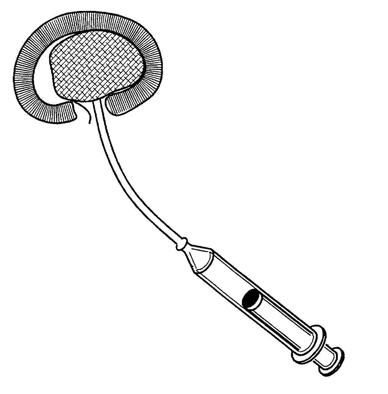 Annulus fibrosis augmentation methods and apparatus