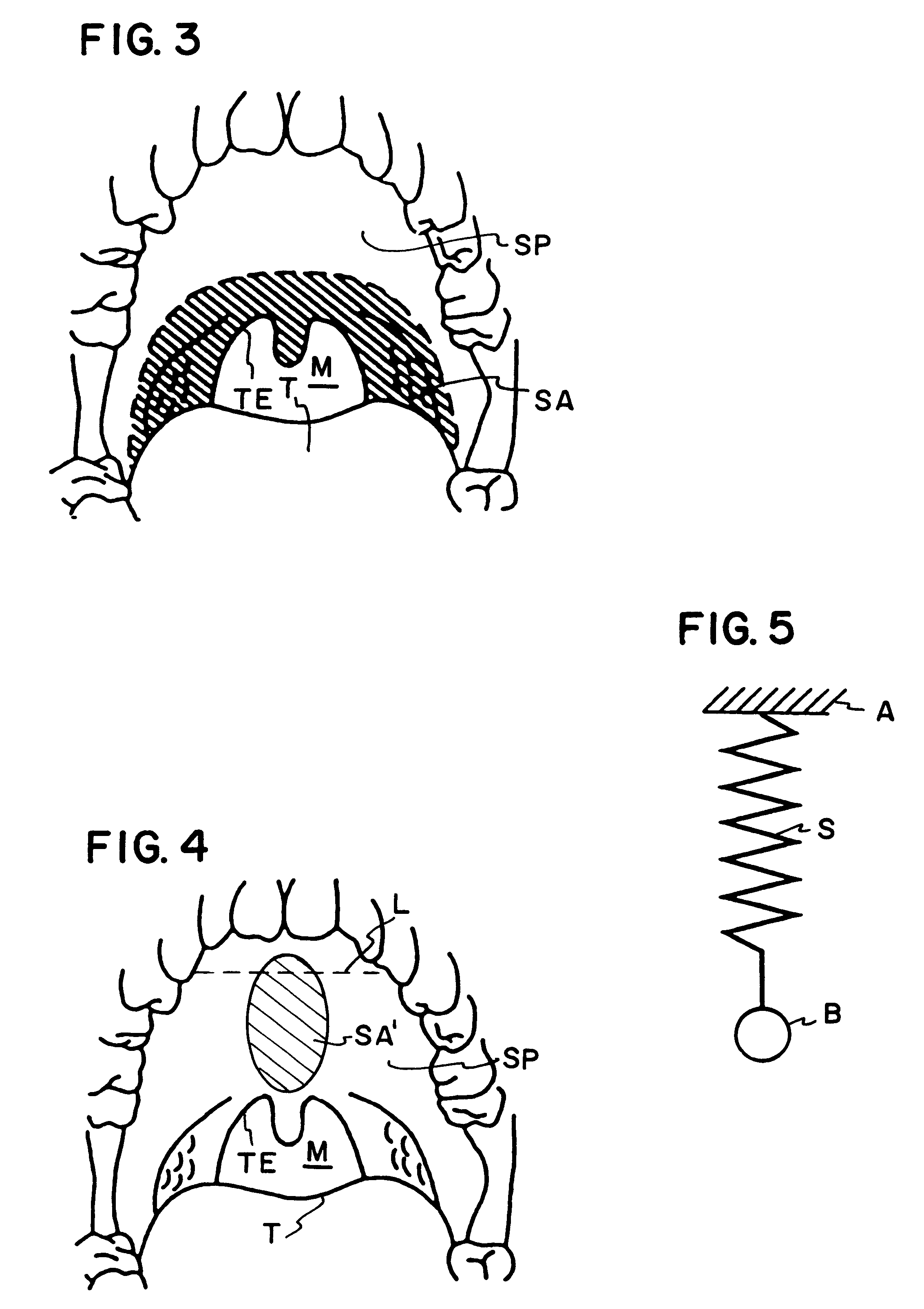 Braided palatal implant for snoring treatment