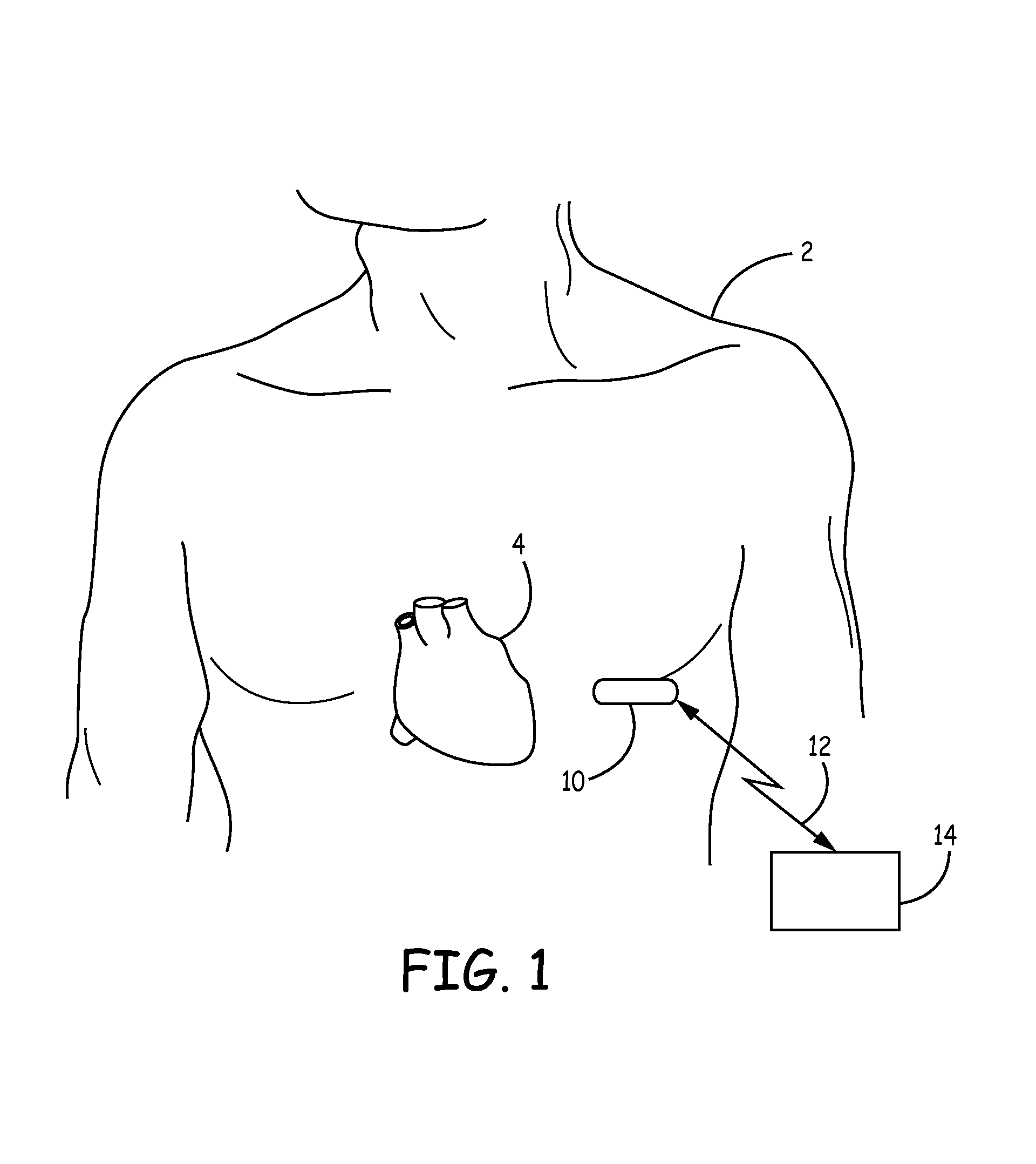 Supply noise rejection in implantable medical devices