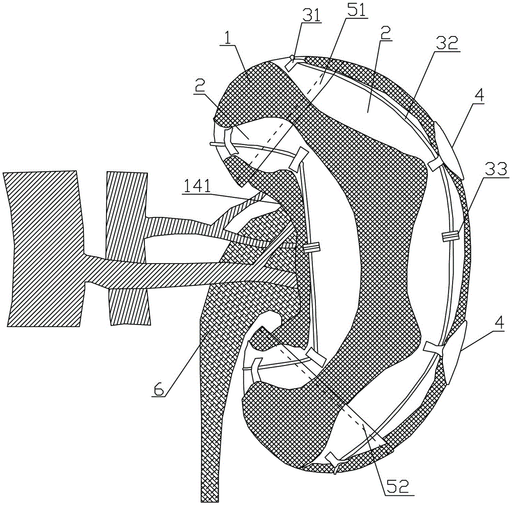 Kidney sleeve device for treating ruptured kidney and method of use thereof