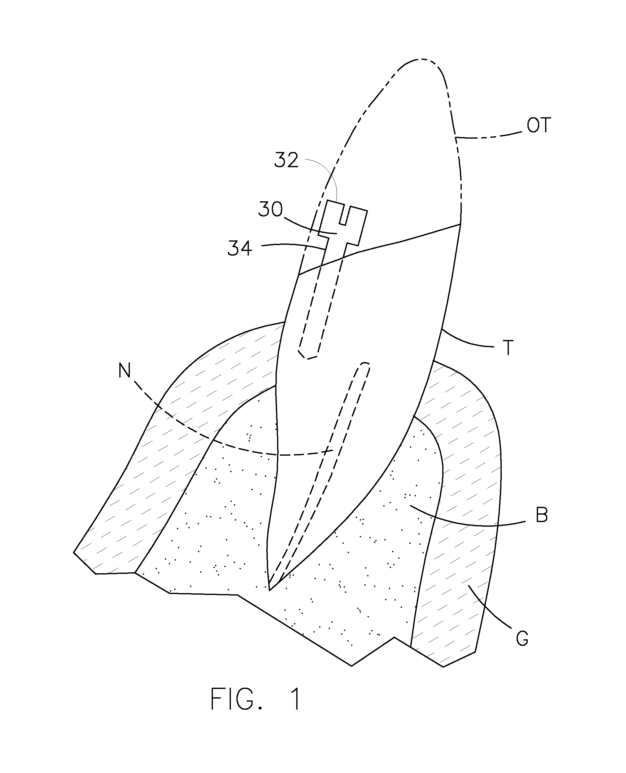 Dental prosthesis for cattle