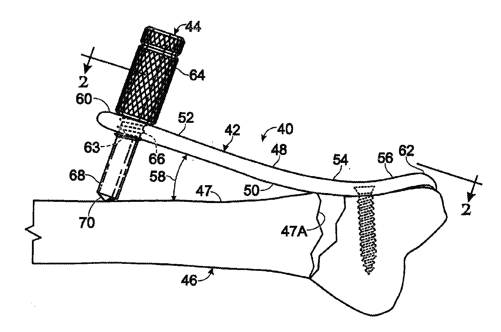 Bone plate supported by a leg member and used as a lever