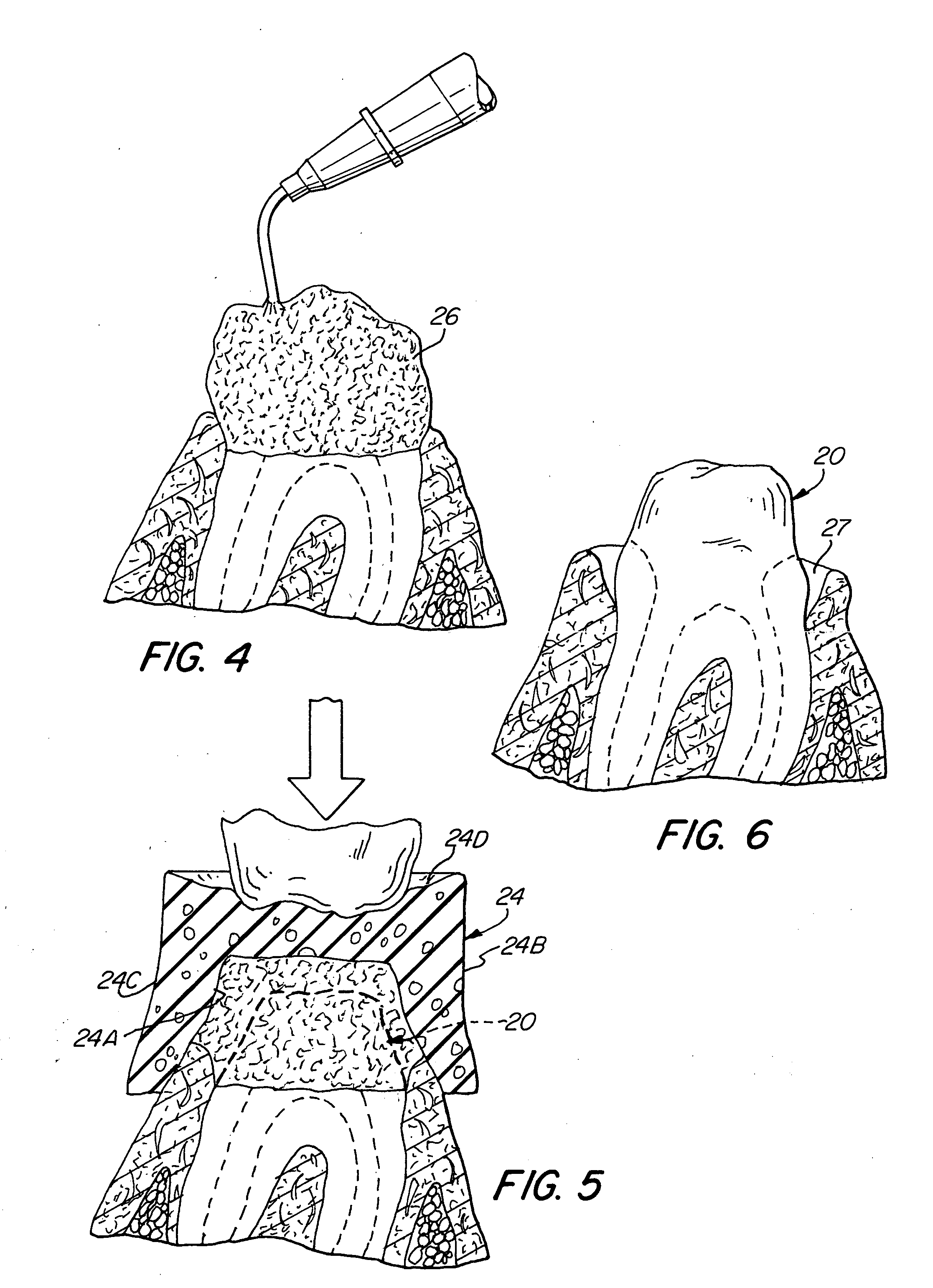 Method and device for the retraction and hemostasis of tissue during crown and bridge procedures