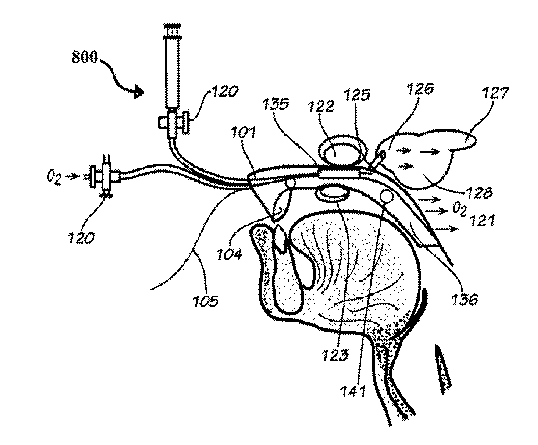 Snoring and obstructive sleep apnea prevention and treatment device