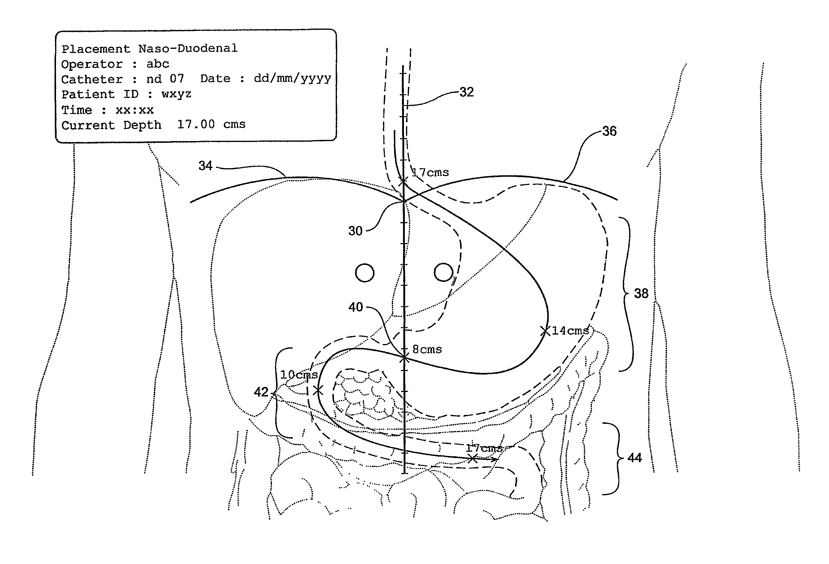 Catheter locator apparatus and method of use