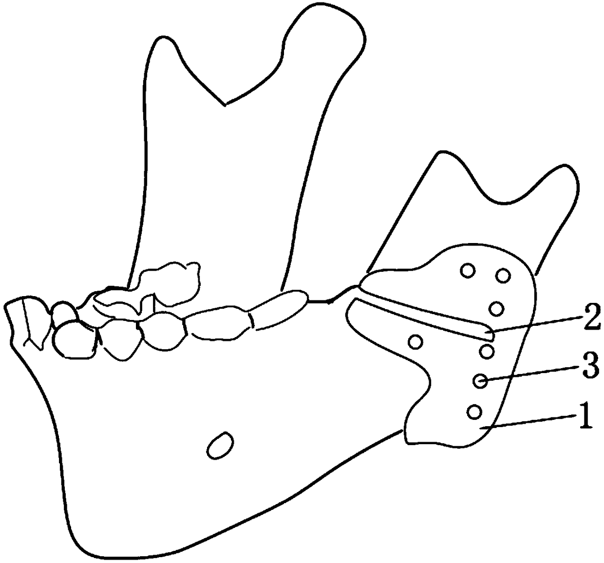 Bone-supporting type mandibular tractor guide plate device and manufacturing method thereof