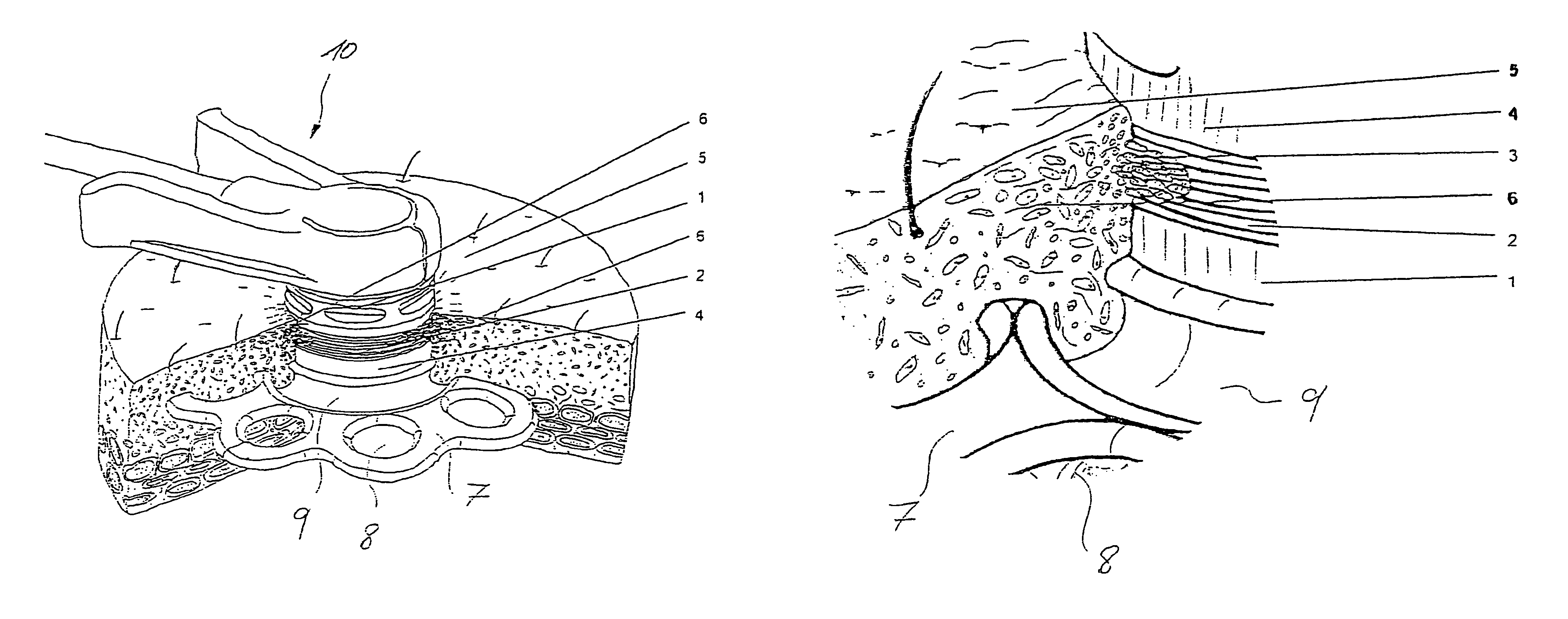 Implant with surface structure