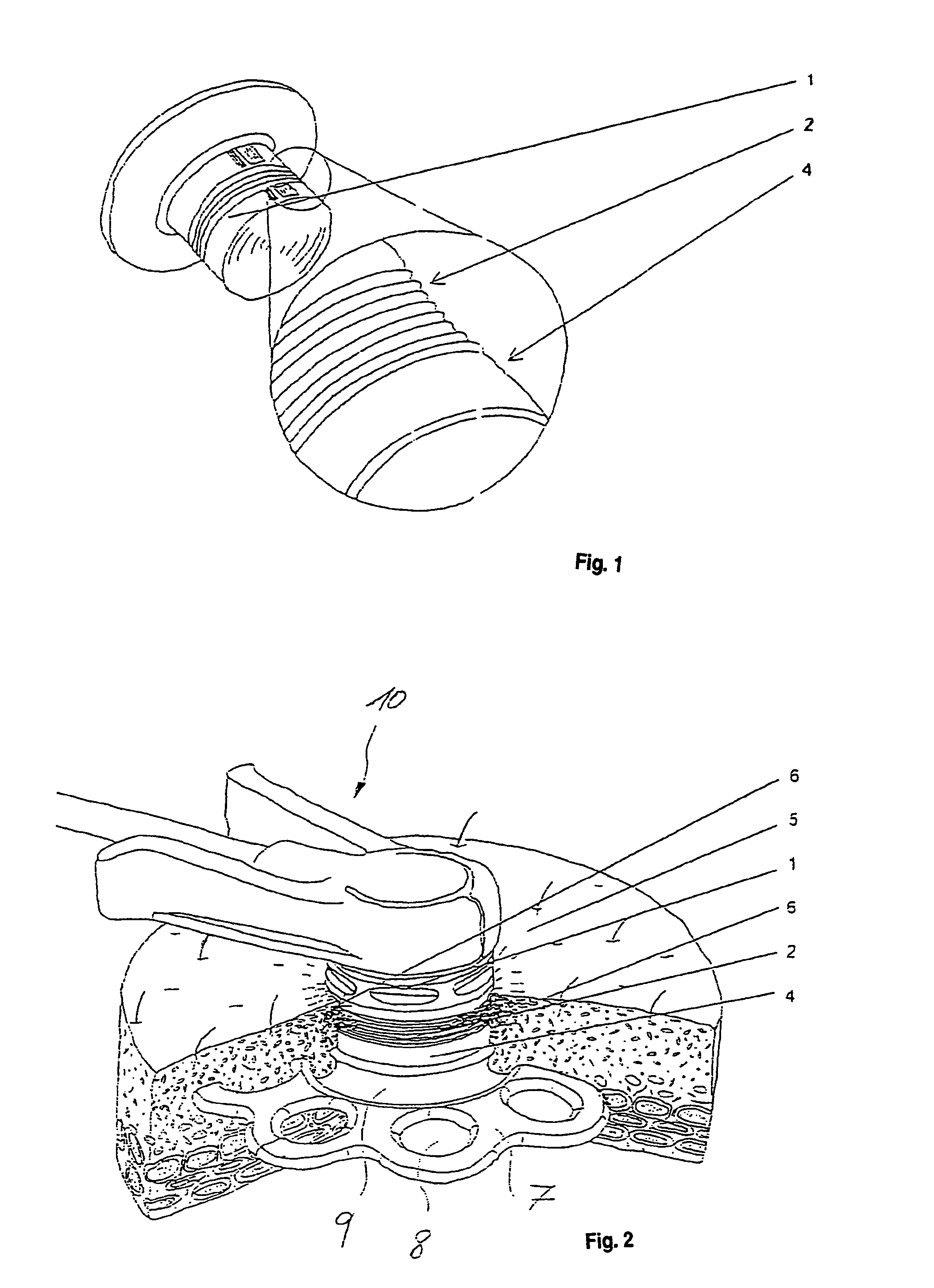 Implant with surface structure